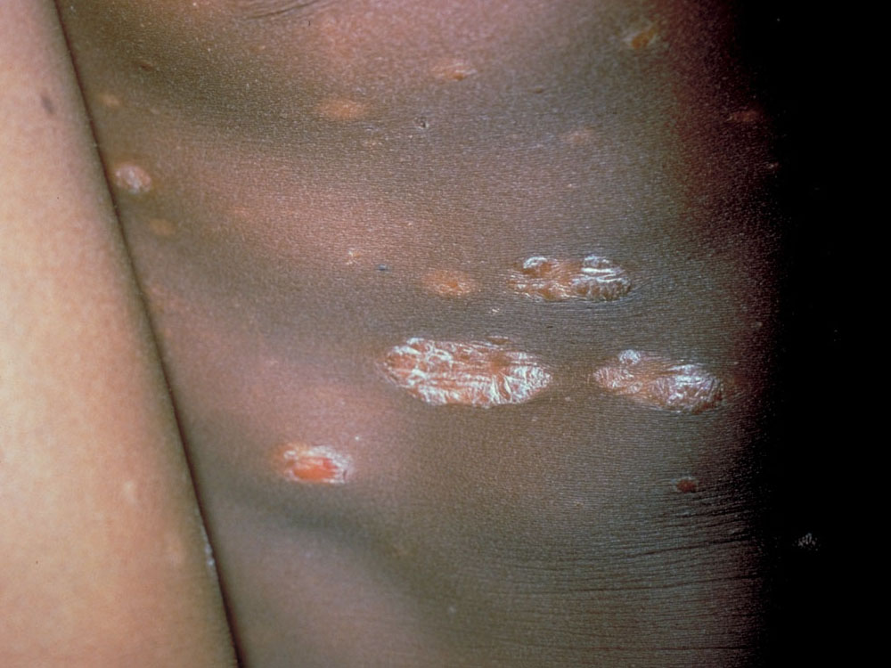 psoriasis
