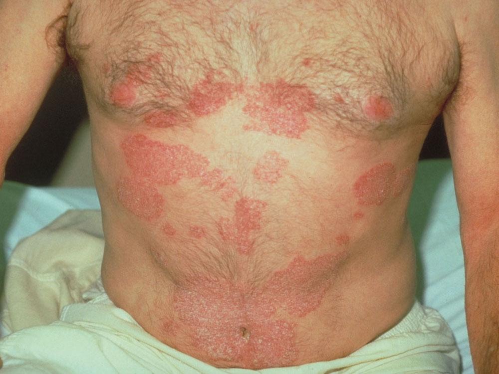 psoriasis