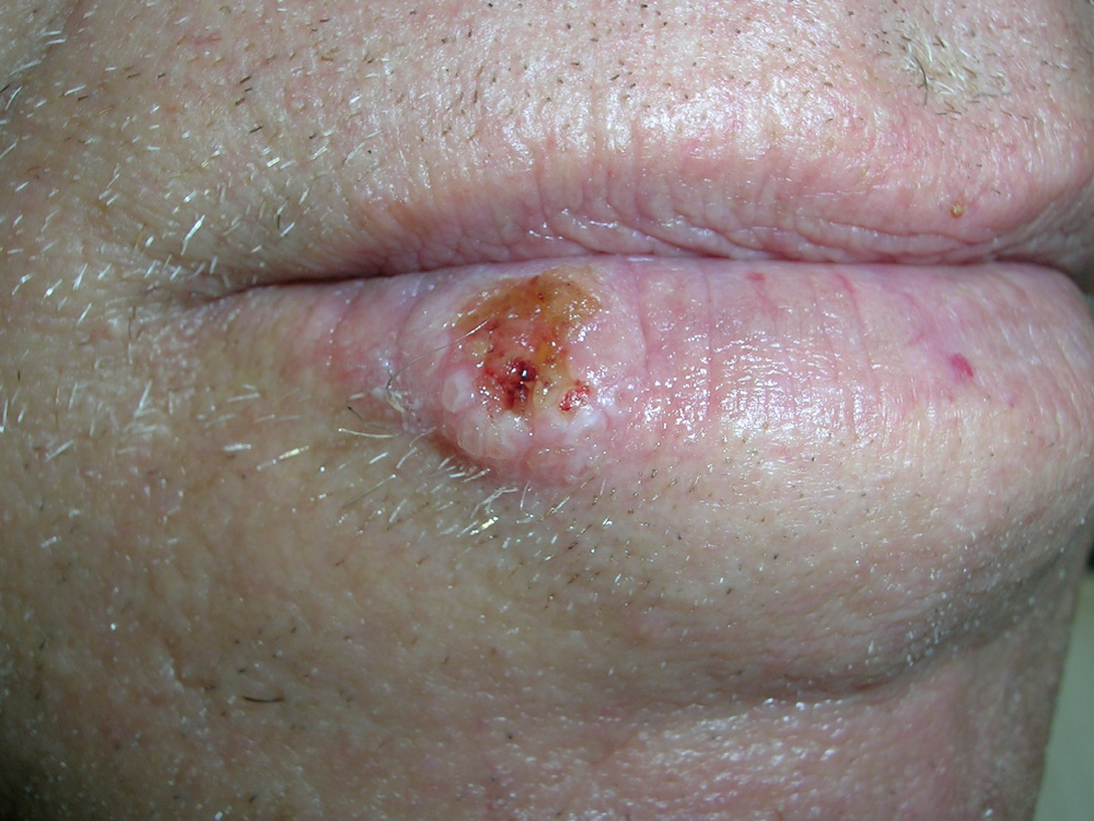 squamous cell carcinoma