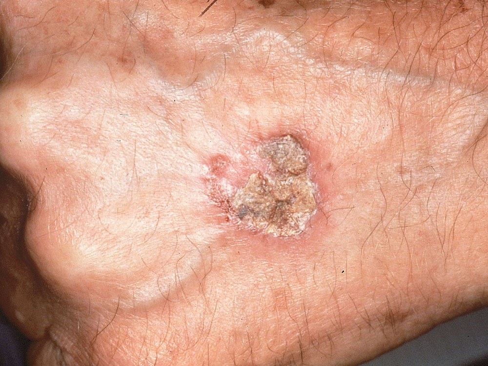 squamous cell carcinoma