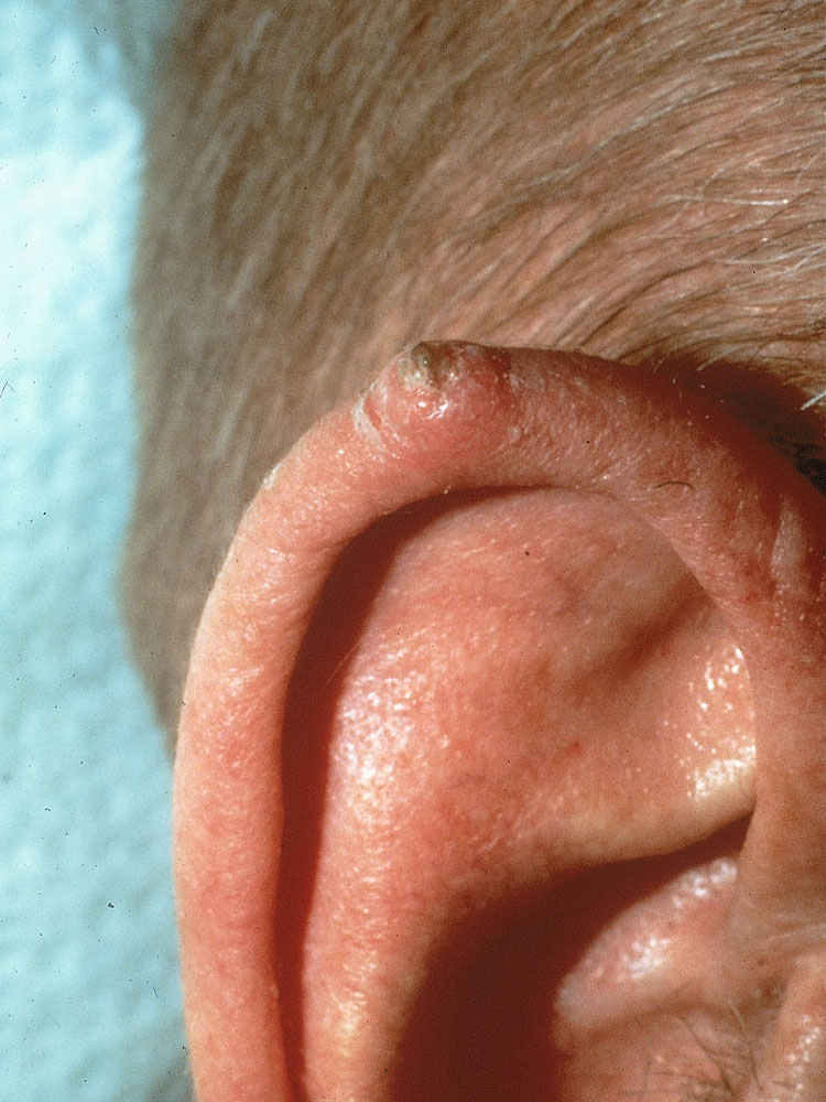 squamous cell carcinoma