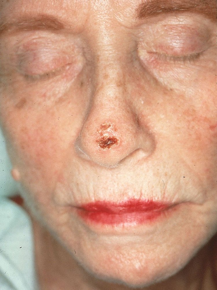 squamous cell carcinoma
