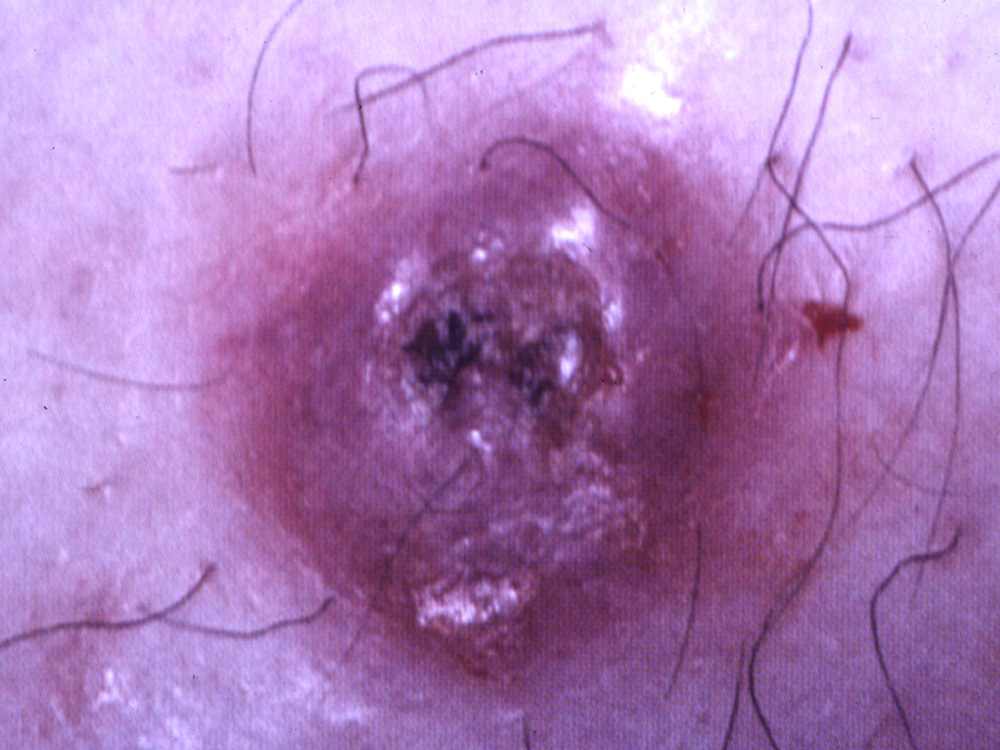 squamous cell carcinoma