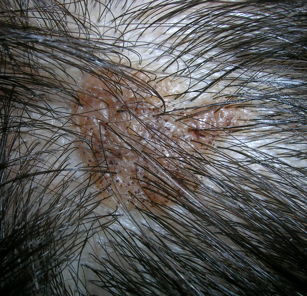 seborrheic keratosis