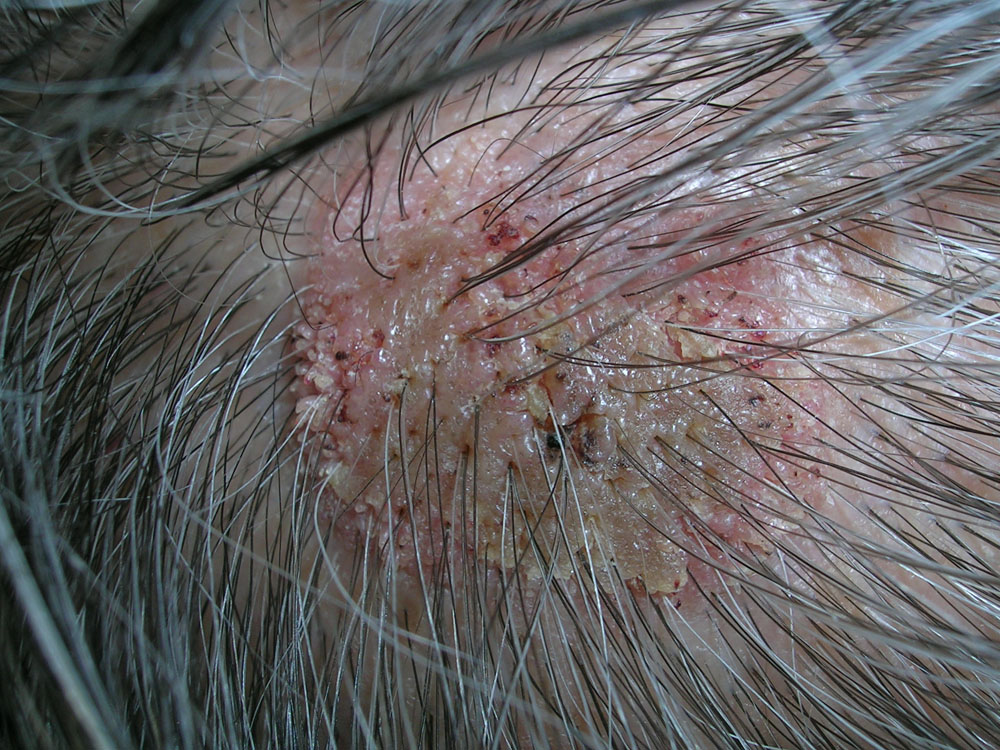 seborrheic keratosis
