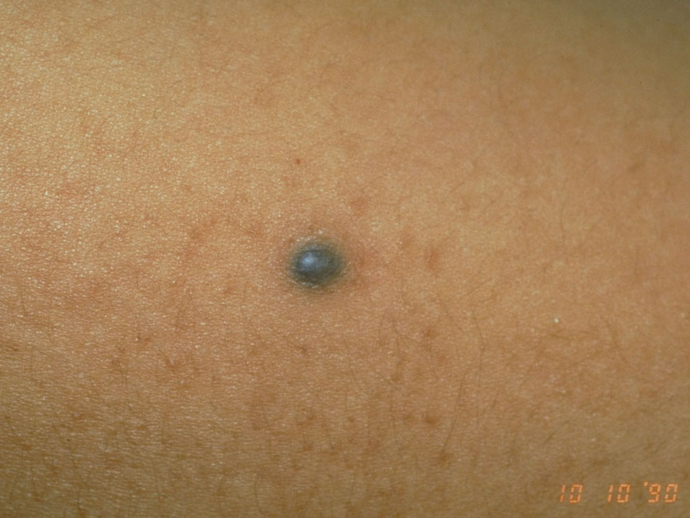 nevus, blue