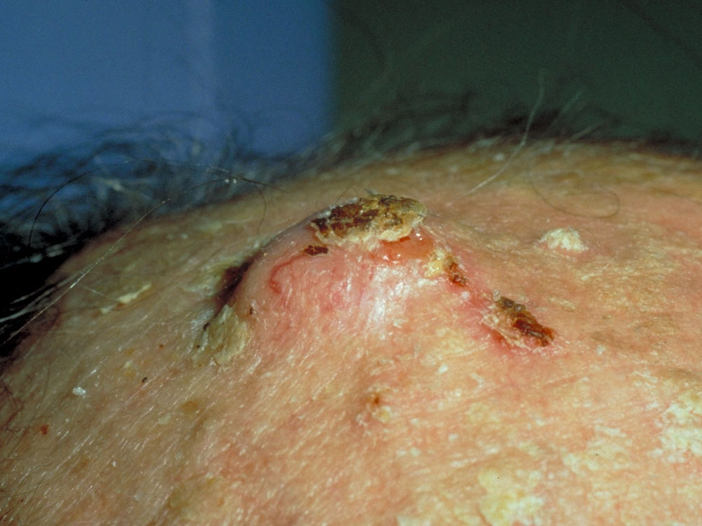 squamous cell carcinoma