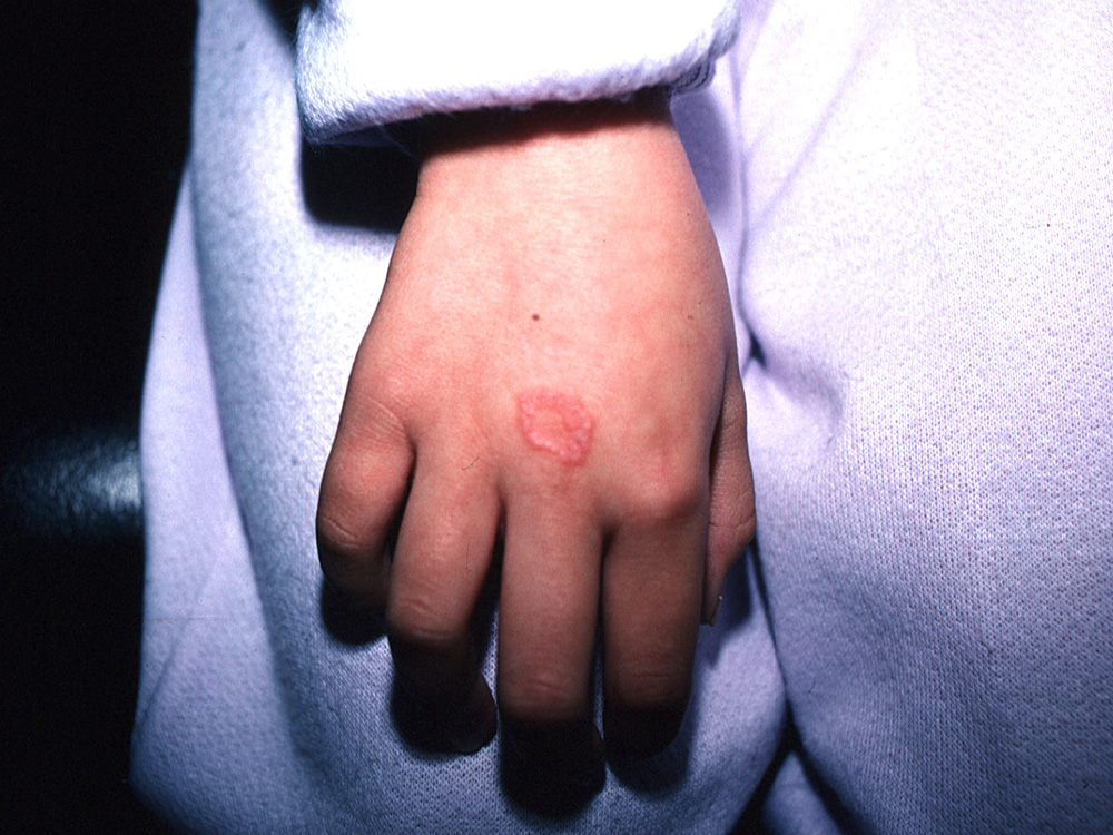 tinea mannum