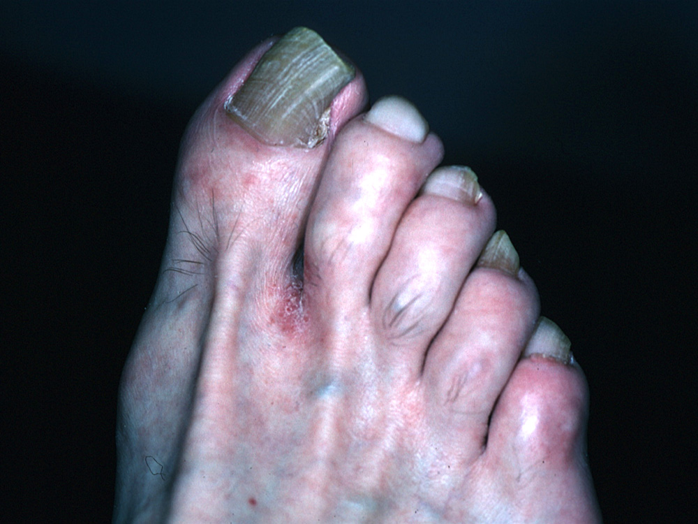 tinea pedis