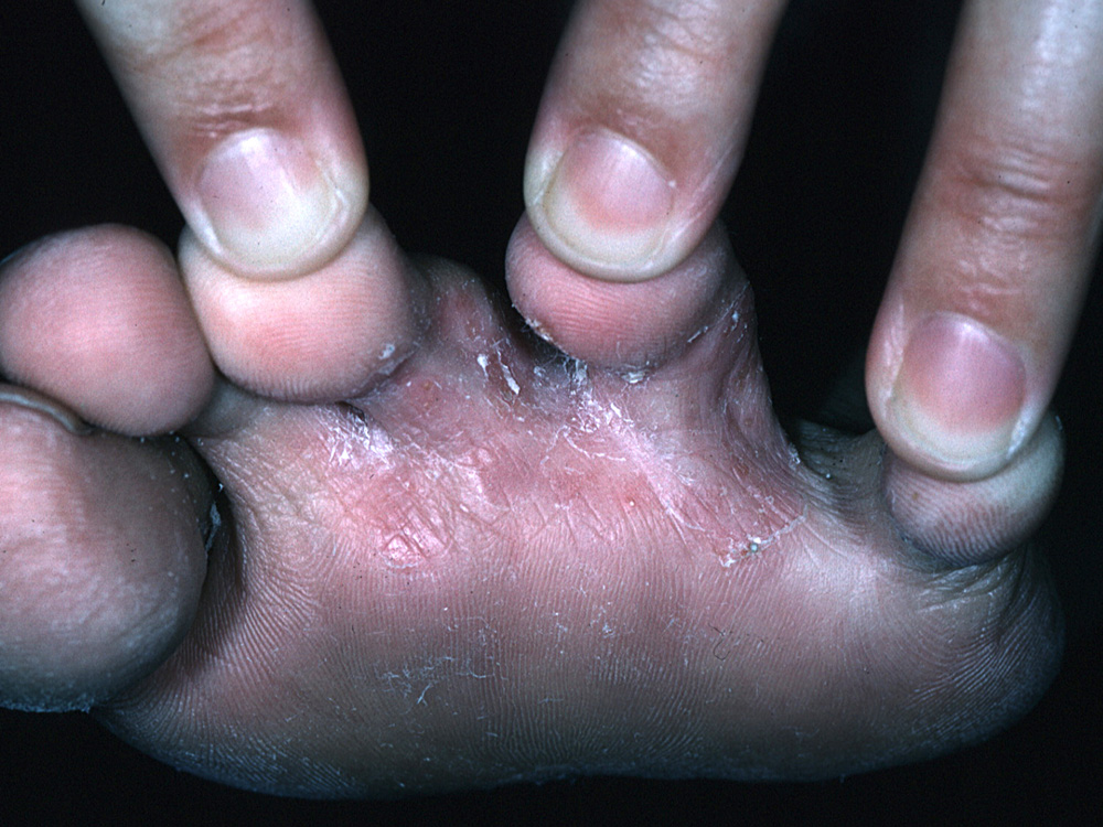 tinea pedis