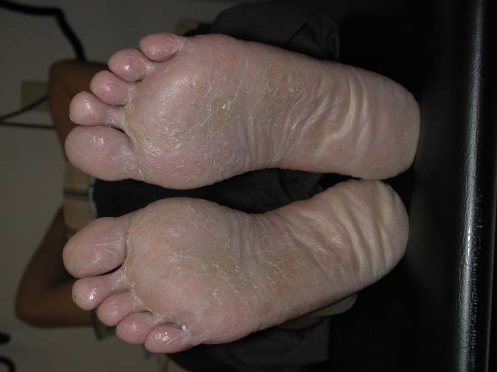 tinea pedis