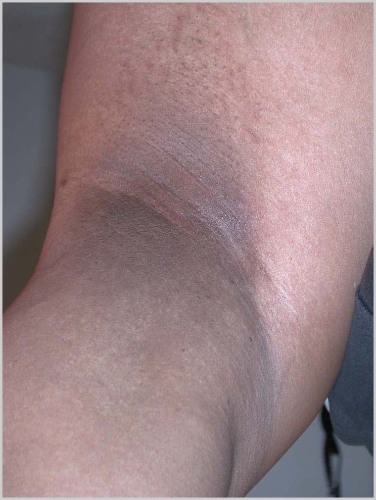 acanthosis nigricans