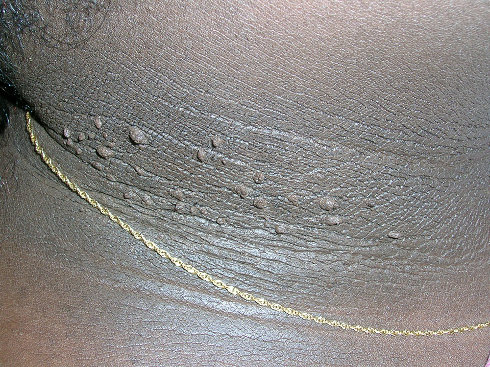 acanthosis nigricans