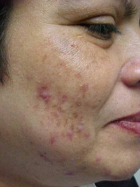 acne
