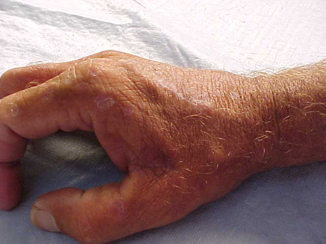 actinic keratosis