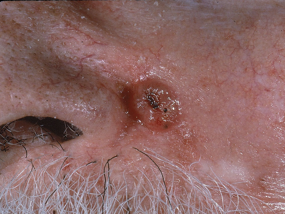 basal cell carcinoma, nodular