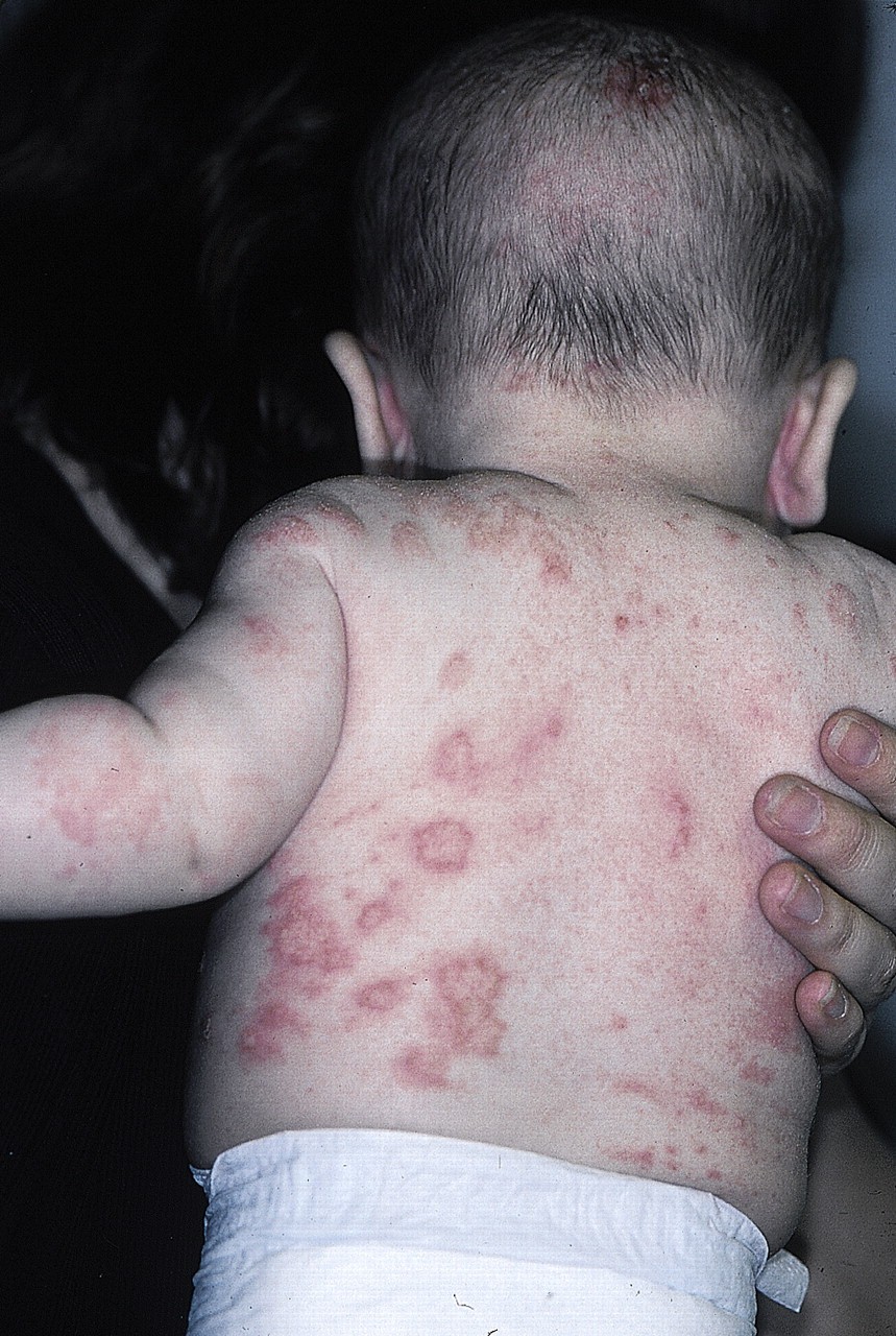atopic dermatitis