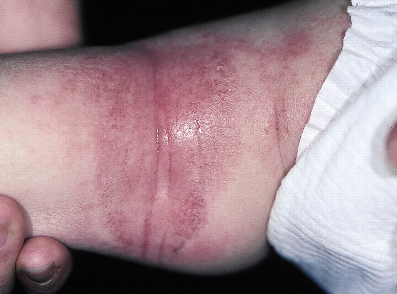 atopic dermatitis