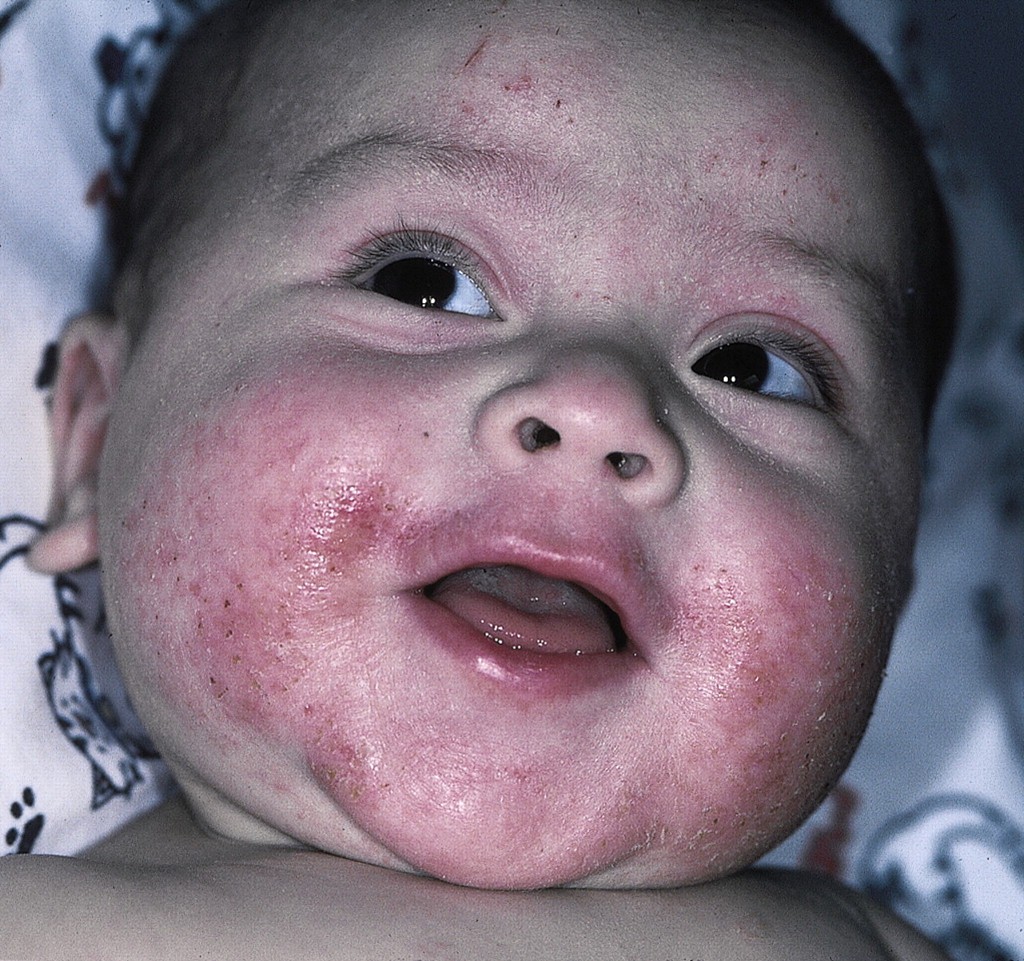 atopic dermatitis