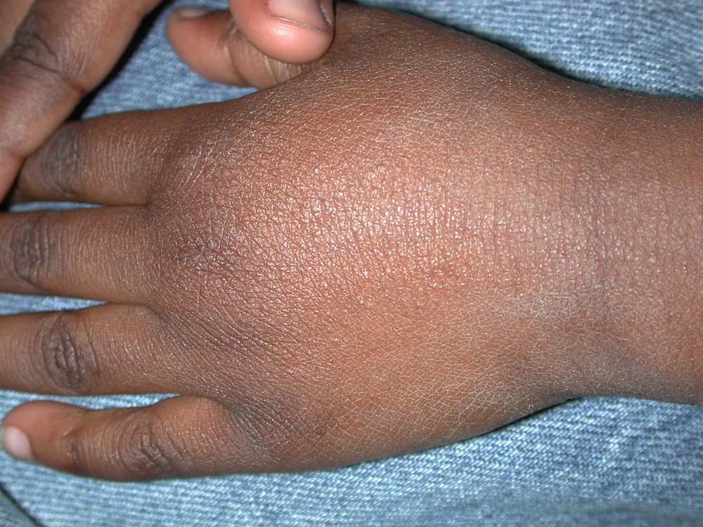 atopic dermatitis