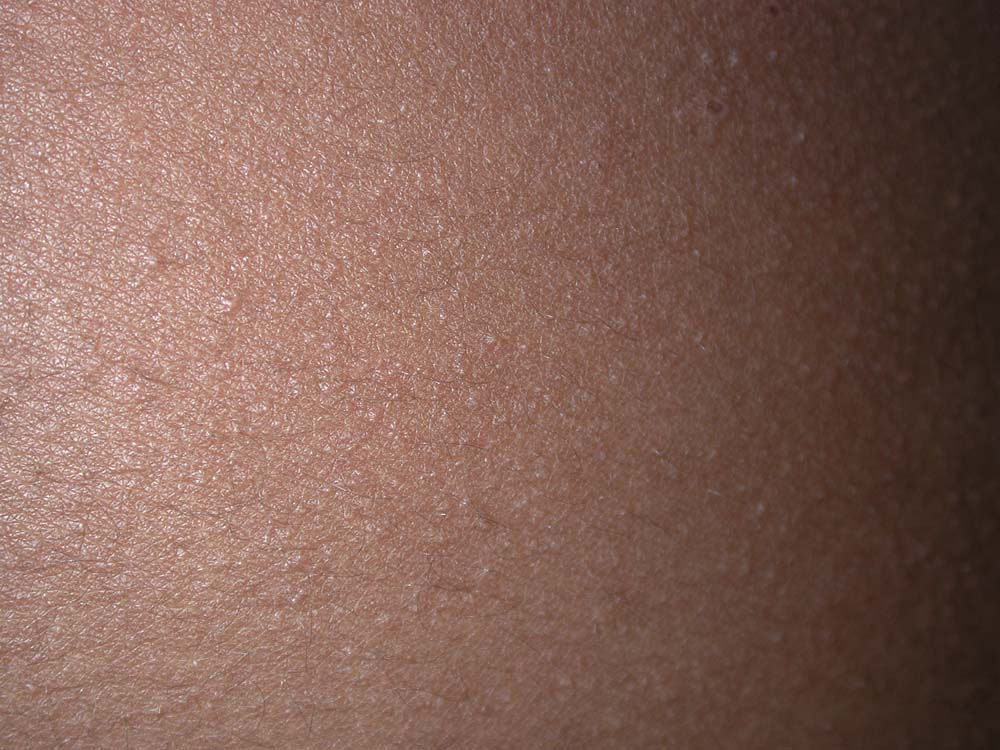 atopic dermatitis