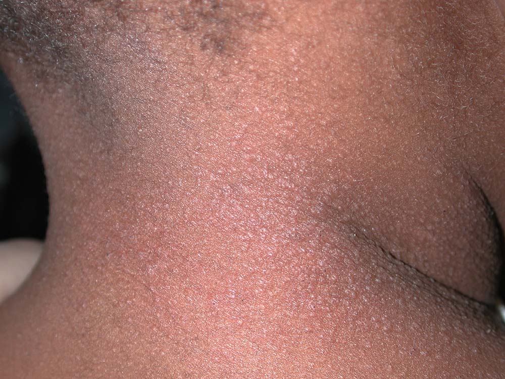 atopic dermatitis