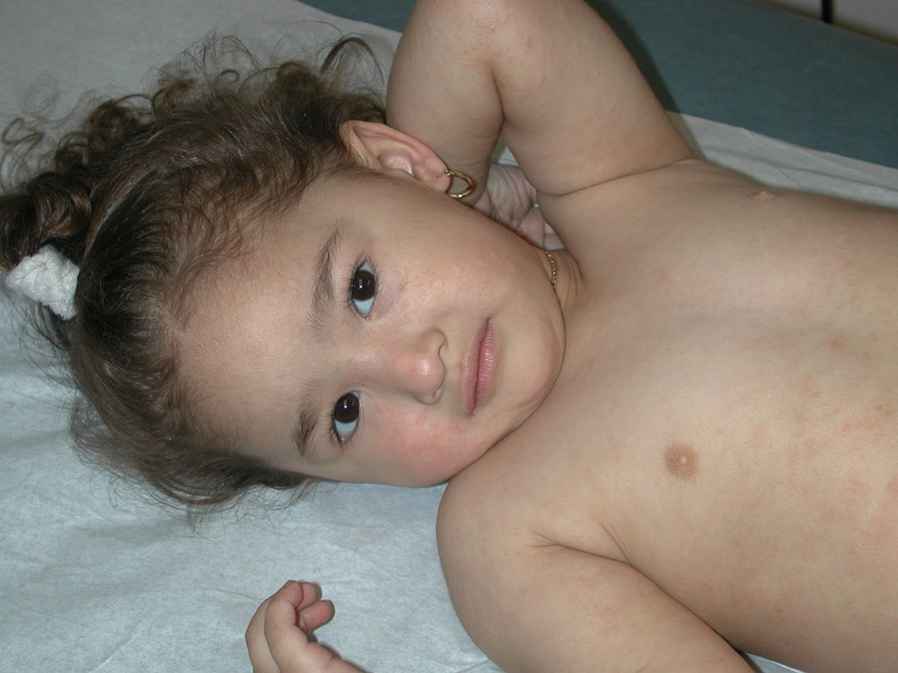 atopic dermatitis
