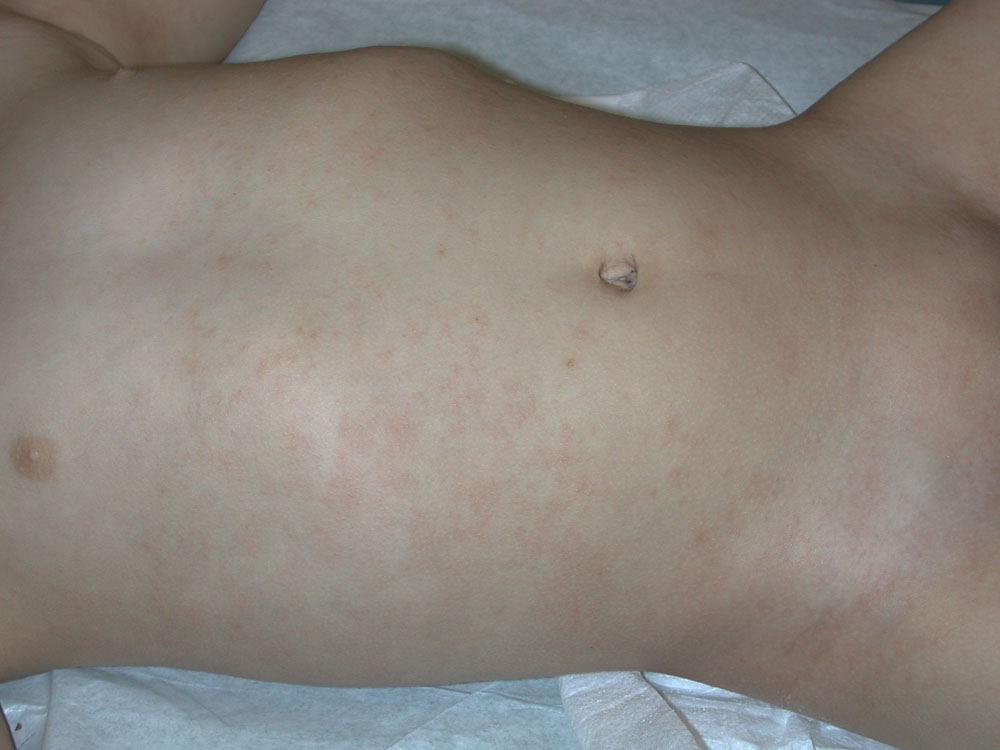 atopic dermatitis