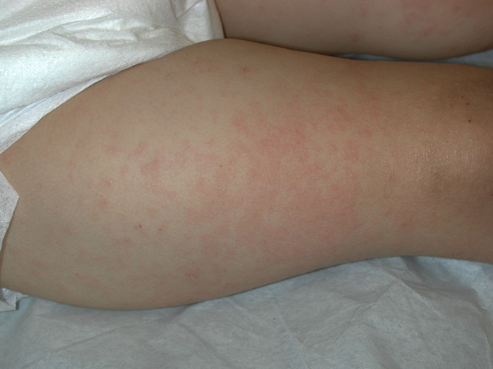 atopic dermatitis