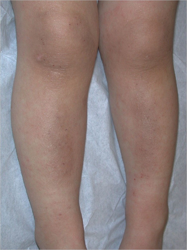 atopic dermatitis
