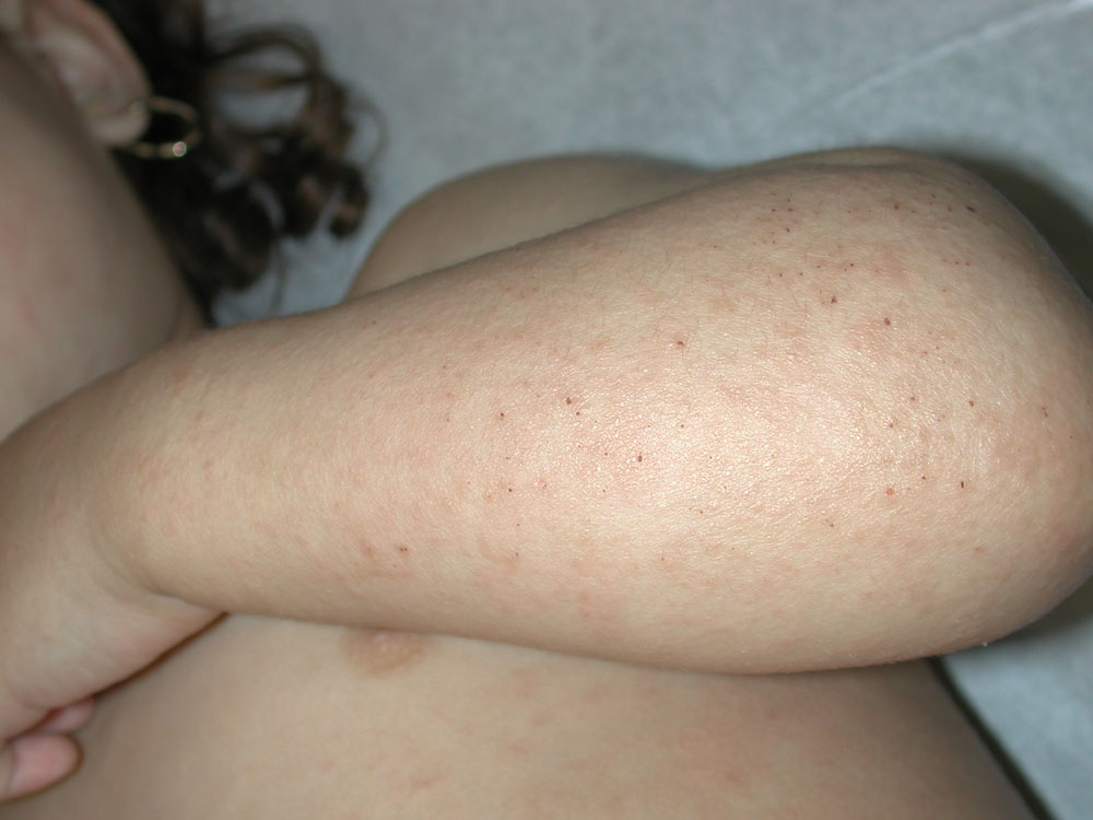 atopic dermatitis