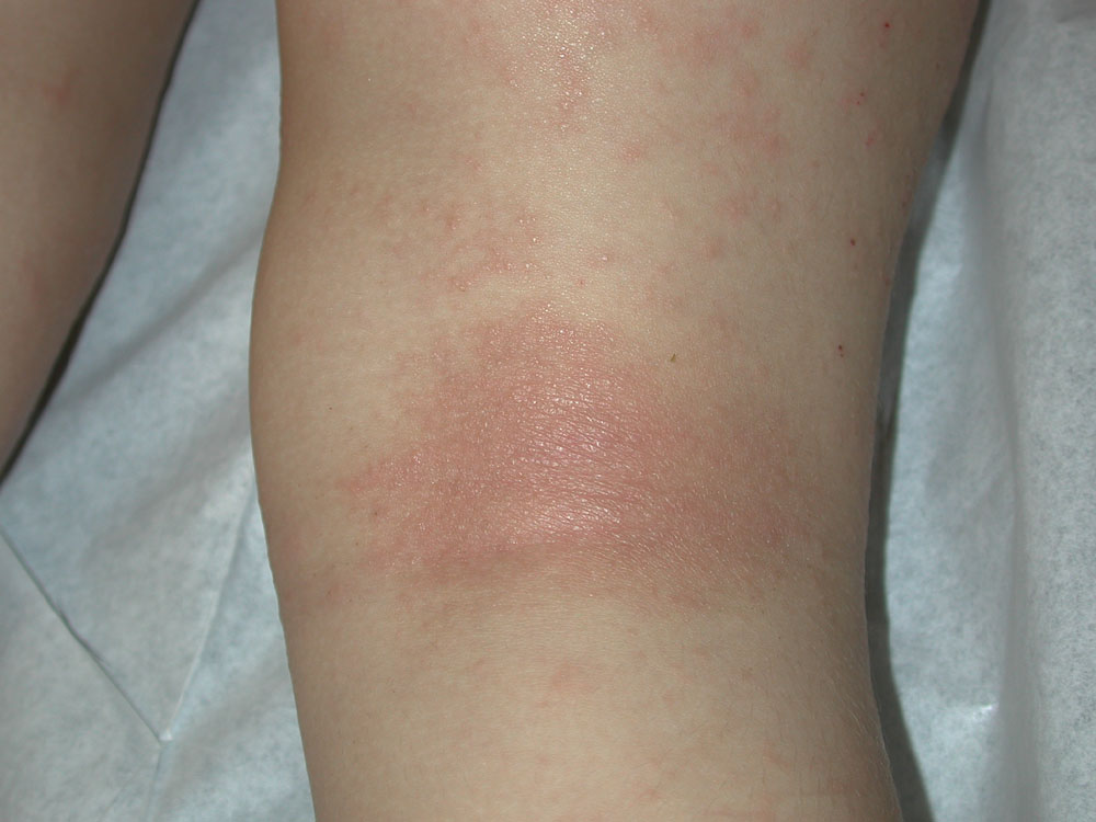atopic dermatitis