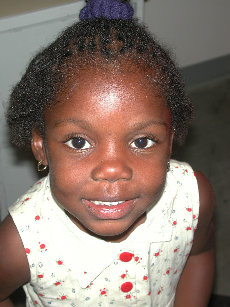 atopic dermatitis