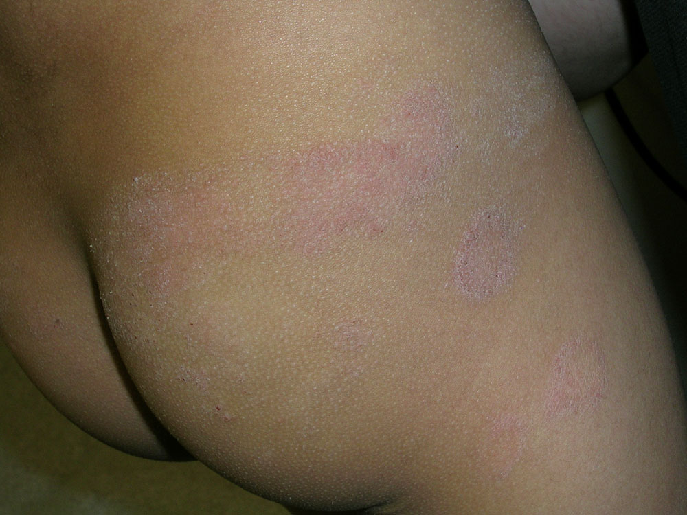 atopic dermatitis