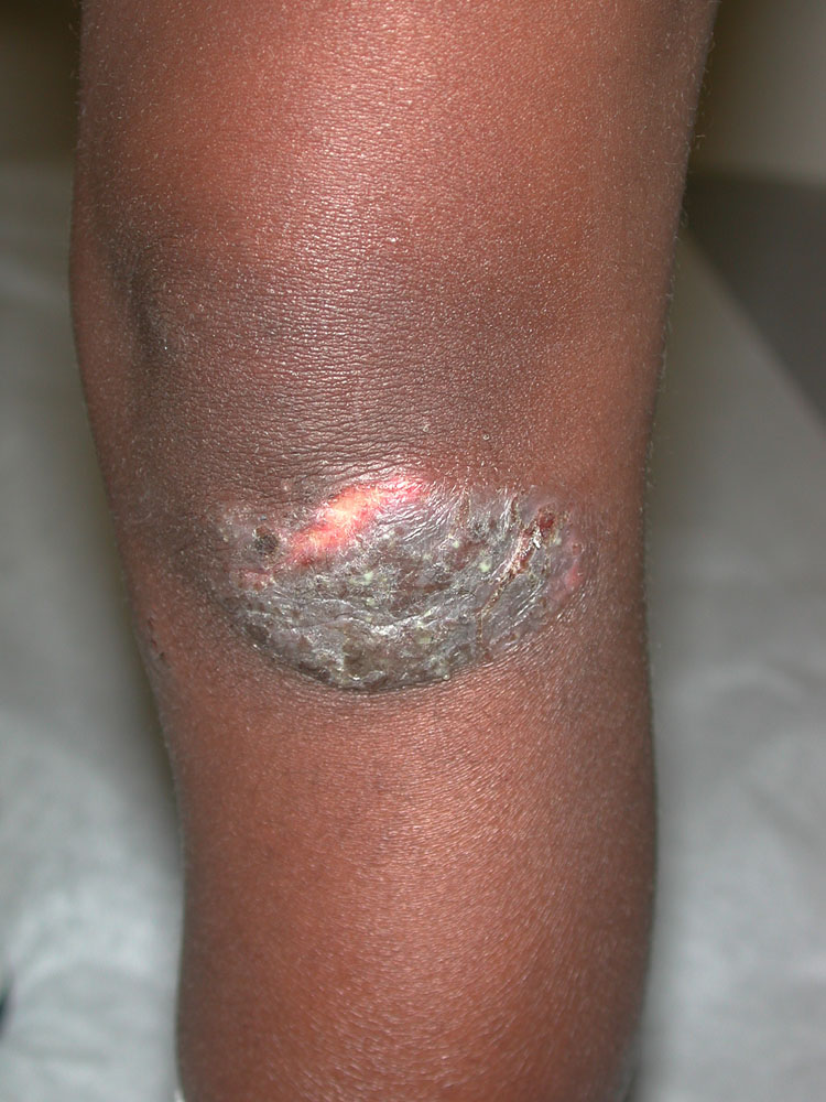 atopic dermatitis