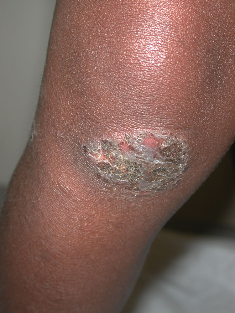 atopic dermatitis