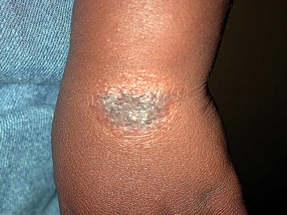 atopic dermatitis