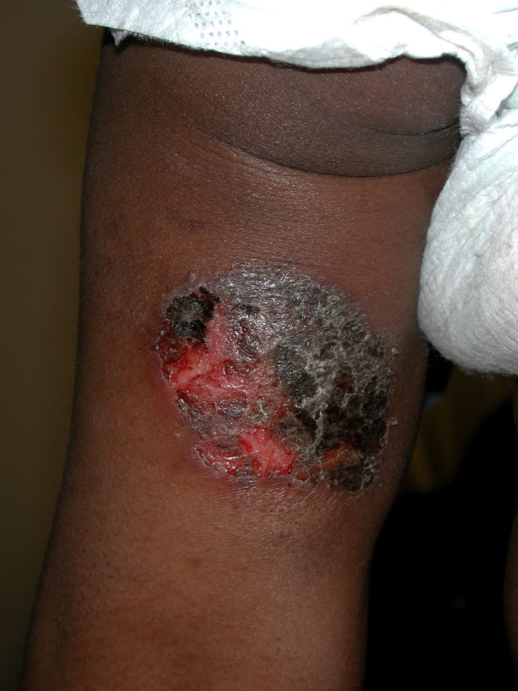 atopic dermatitis