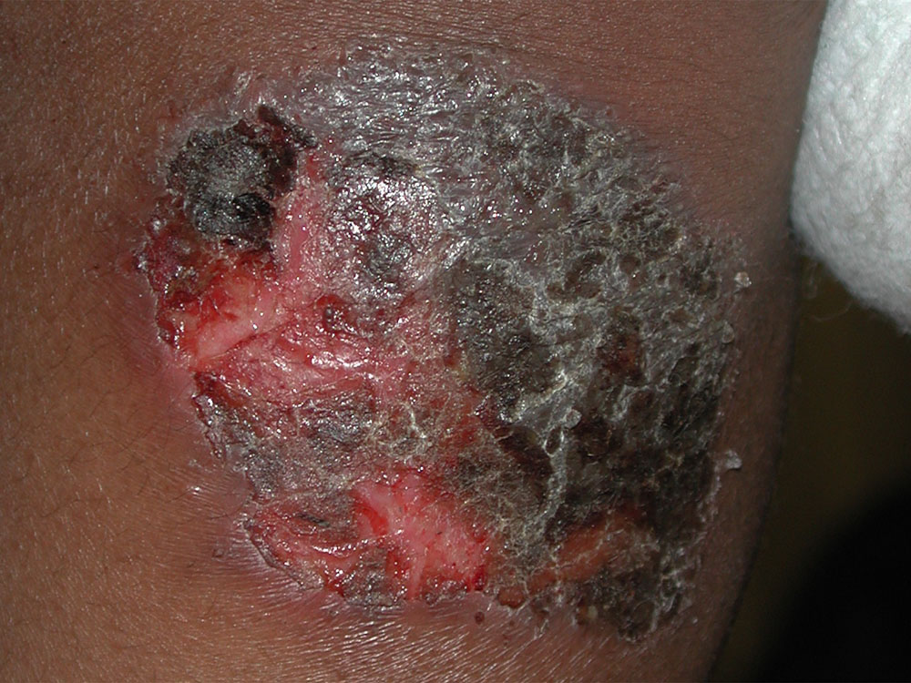 atopic dermatitis