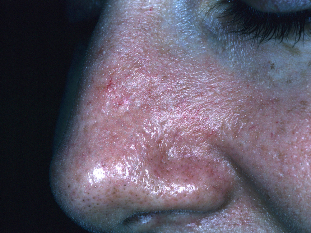 basal cell carcinoma, nodular
