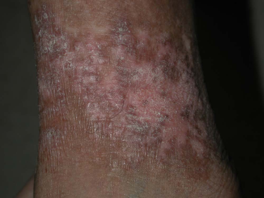 eczema
