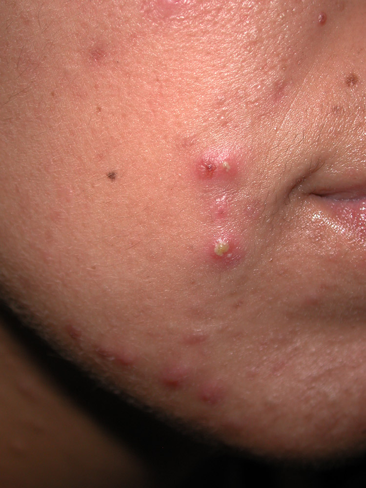 acne