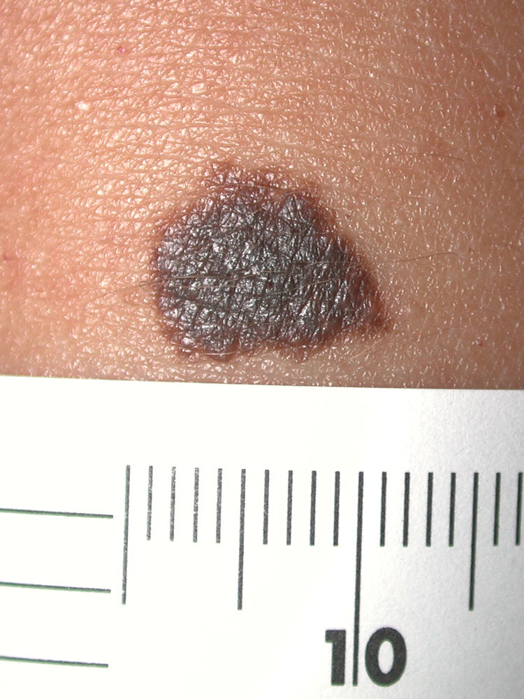 nevus, congenital