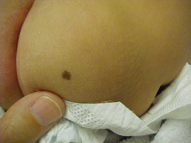 nevus, congenital