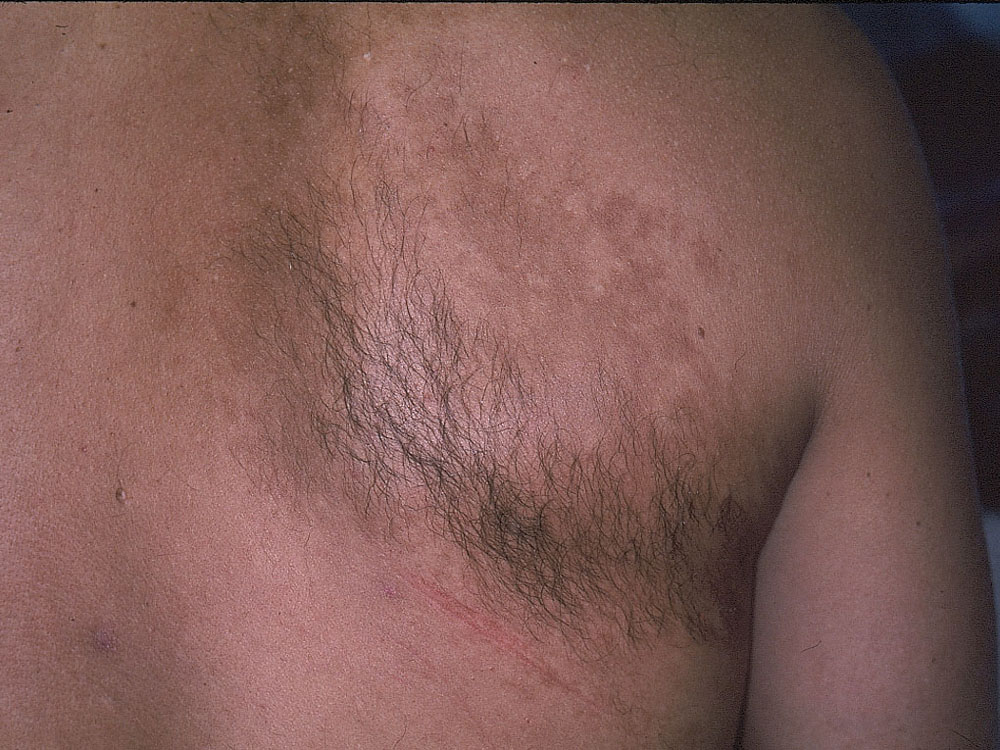 nevus, congenital