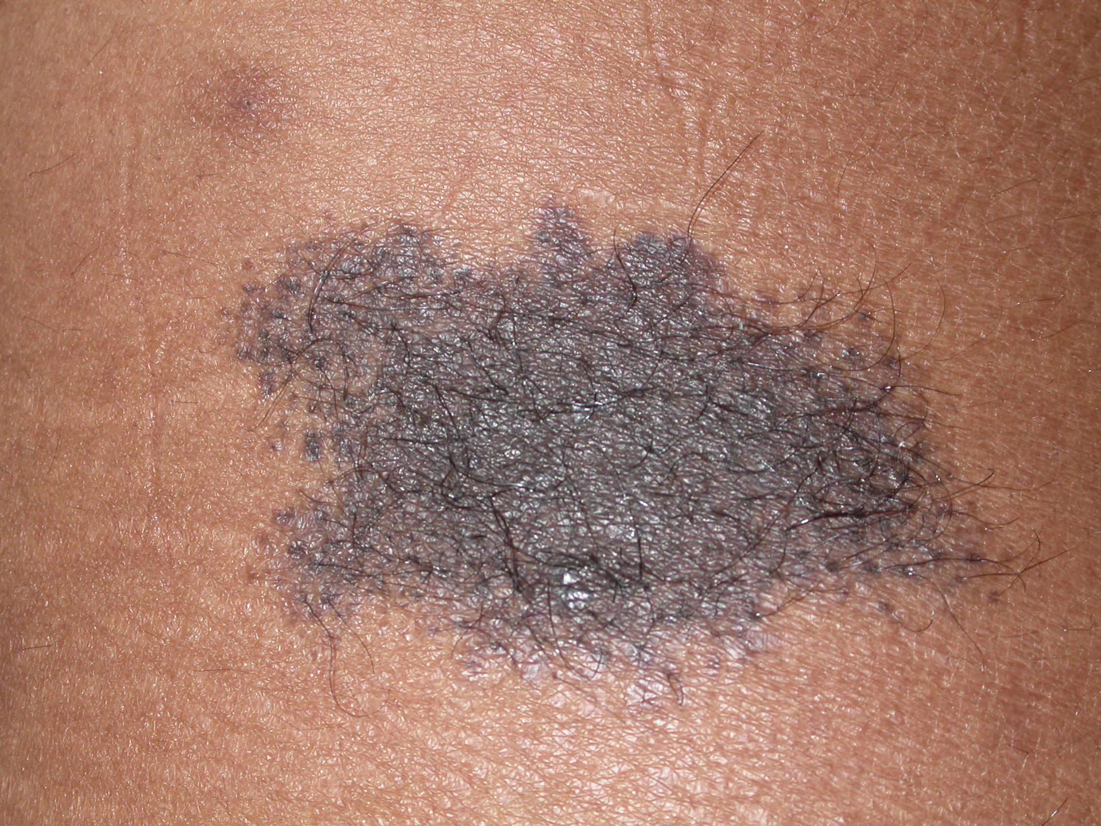 nevus, congenital