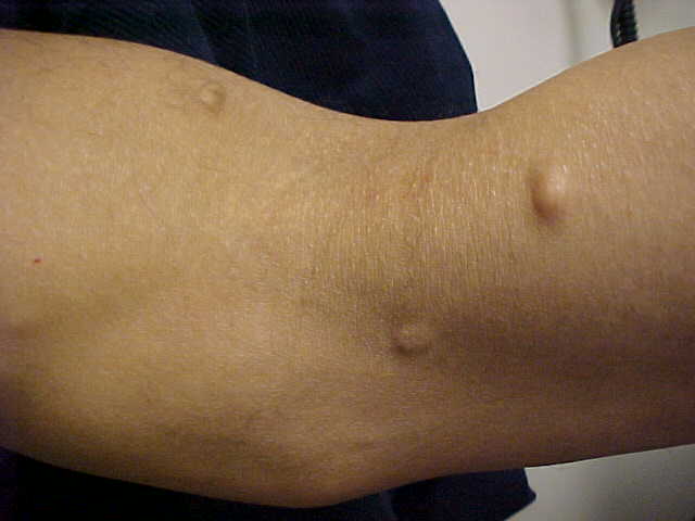 cyst, epidermal