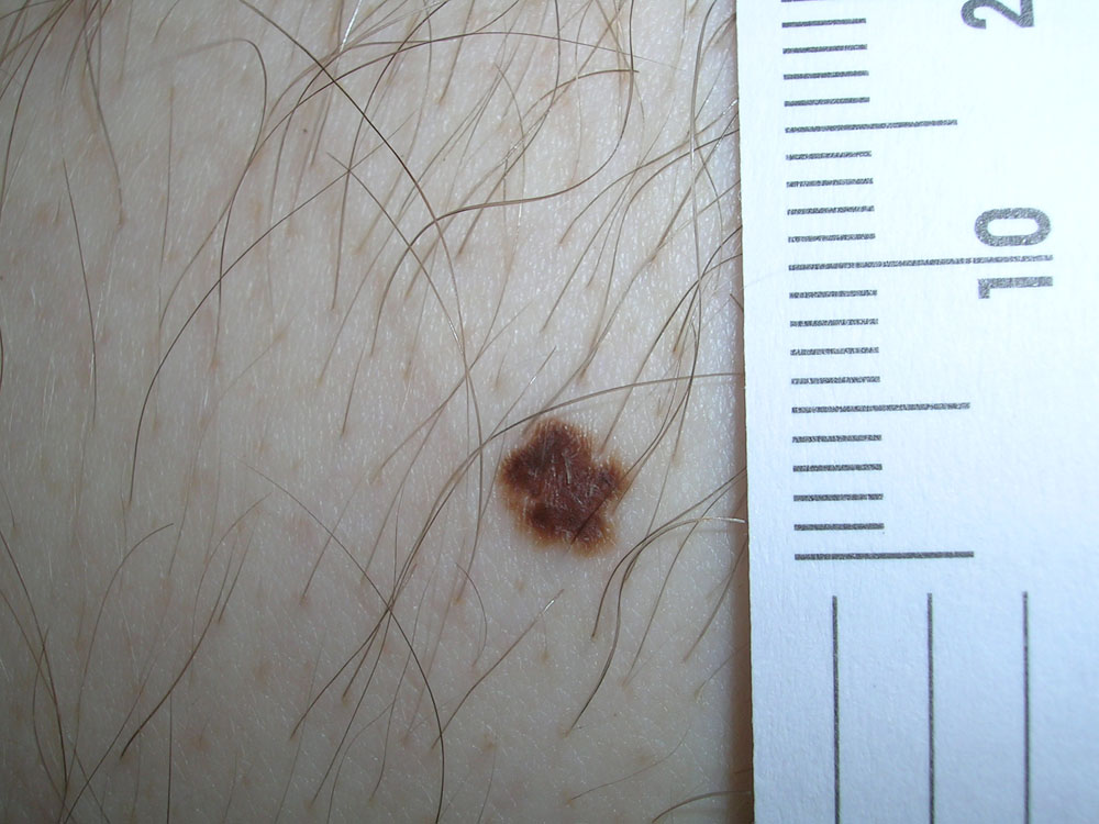 nevus, dysplastic