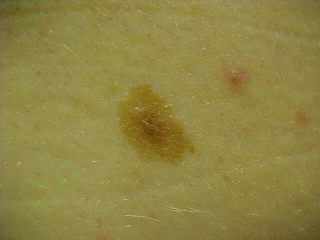 nevus, dysplastic
