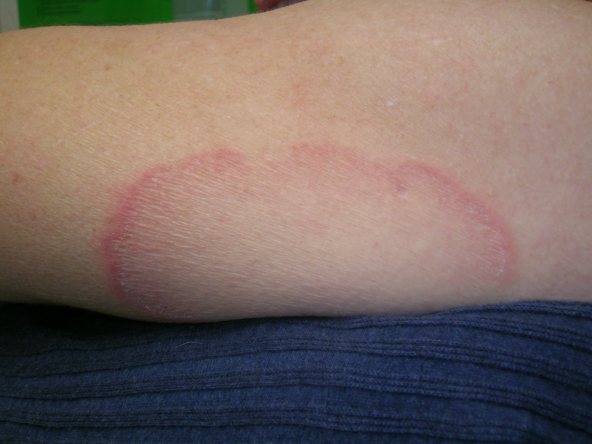 erythema annulare centrifugum